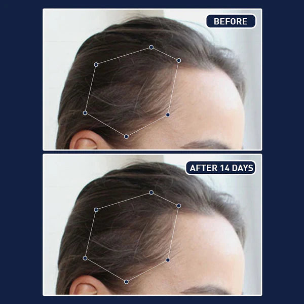 🎁عرض اليوم: خصم 𝟔𝟓% على 𝐅𝐄𝐆™ - بخاخ نمو الشعر