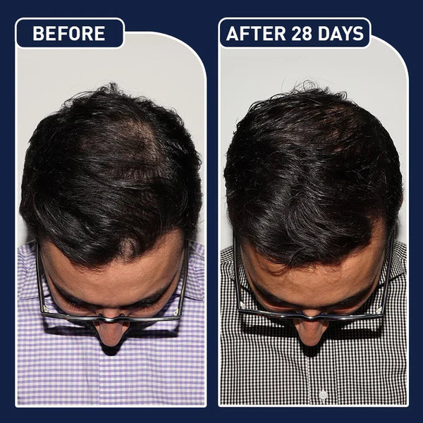 🎁عرض اليوم: خصم 𝟔𝟓% على 𝐅𝐄𝐆™ - بخاخ نمو الشعر